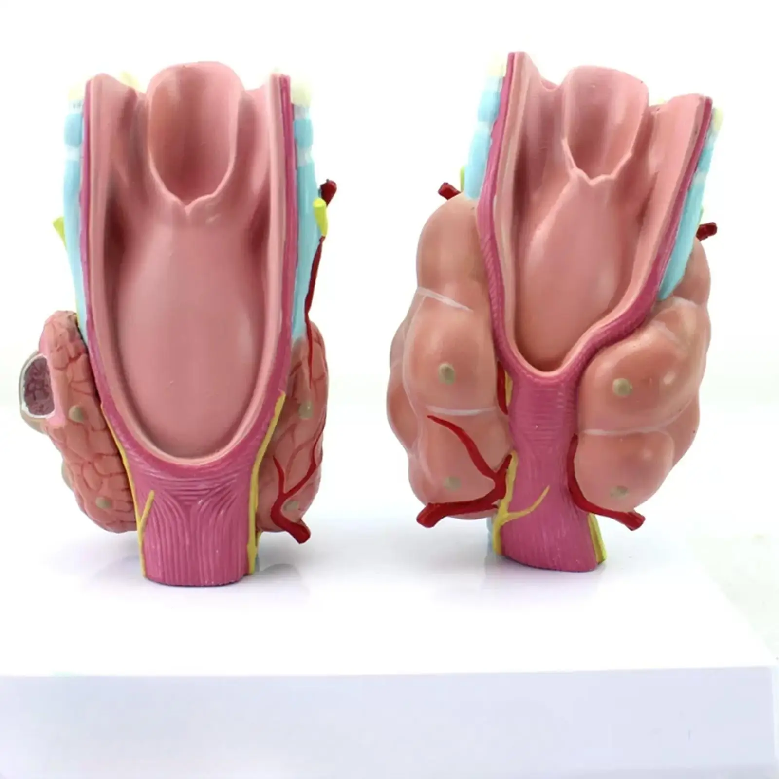 Патология на щитовидната жлеза човек Тумор в Модел на рак на щитовидната жлеза Медицинска школа Изображение 1