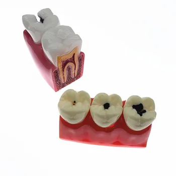 4 пъти/6 пъти на Модел за Сравняване на Кариозен Зъб Стоматологично Изследване на Образователна Демонстрация